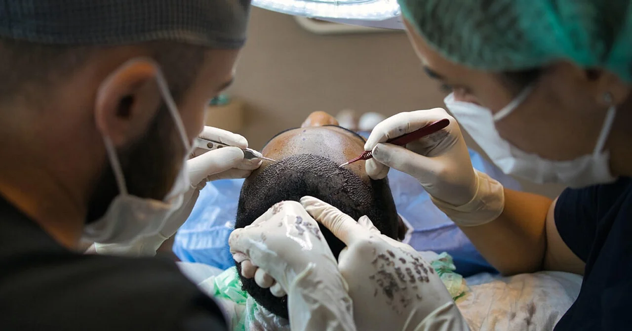 Stem Cell Therapy for Hair Restoration: A Patient's Guide